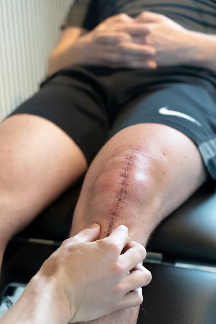 Fysiotherapeut ondersteunt met beide handen een knie met litteken na een operatie